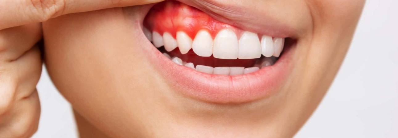 歯周病のイメージ