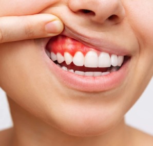 歯周病のイメージ