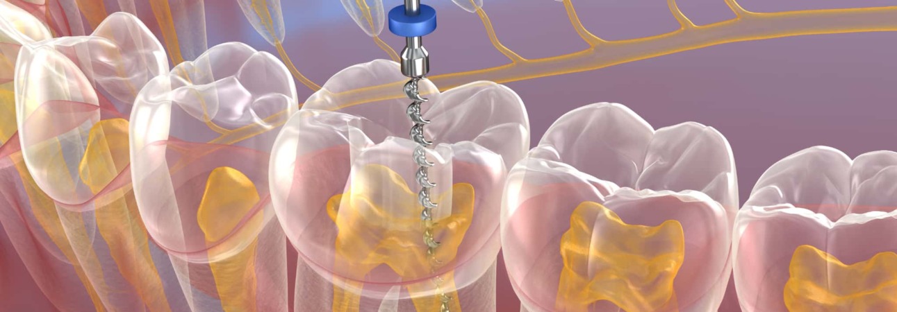 根管治療のイメージ