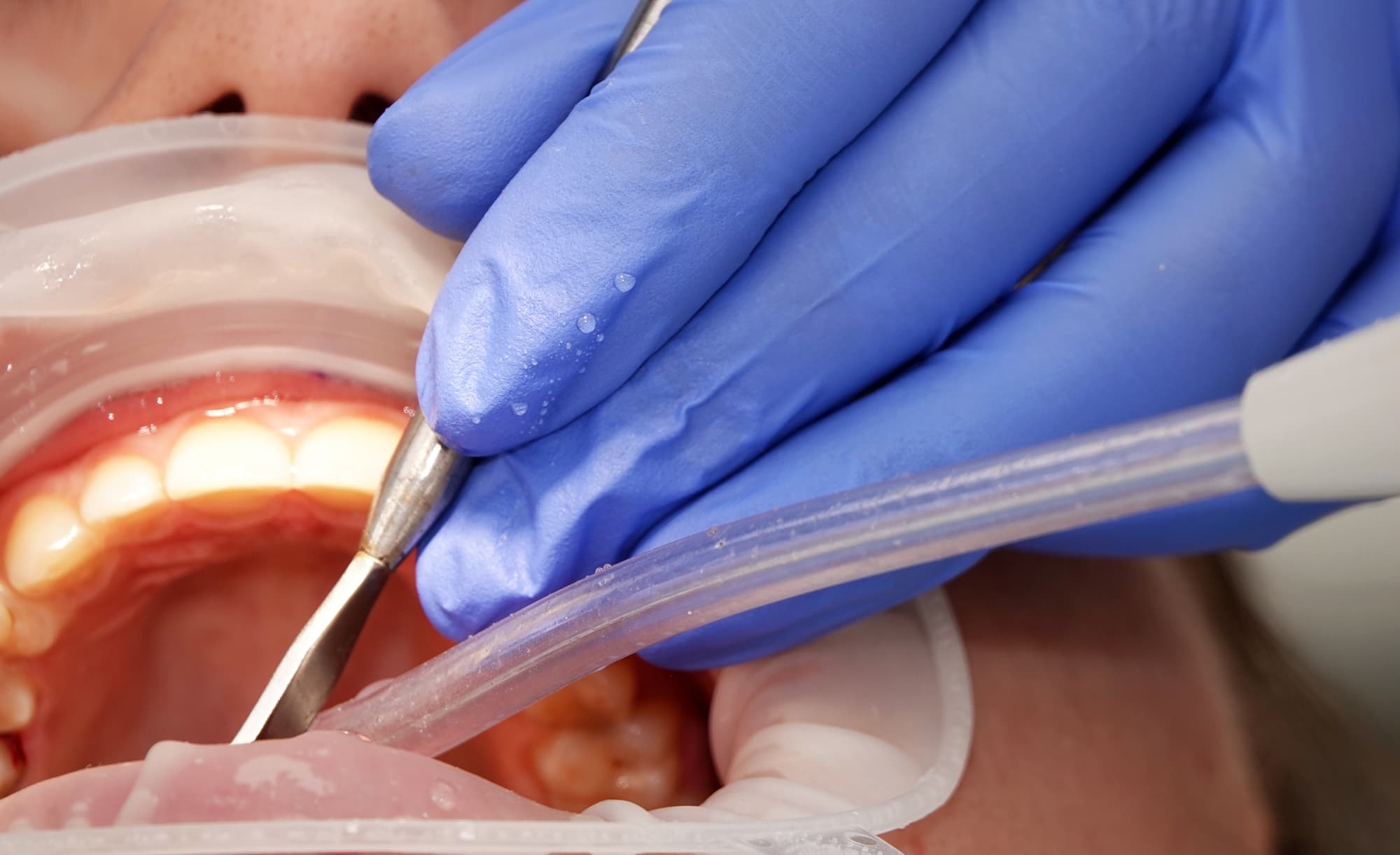 歯周外科治療の施術