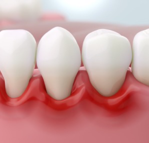 歯周病のイメージ