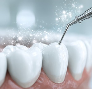 歯のクリーニングのイメージ