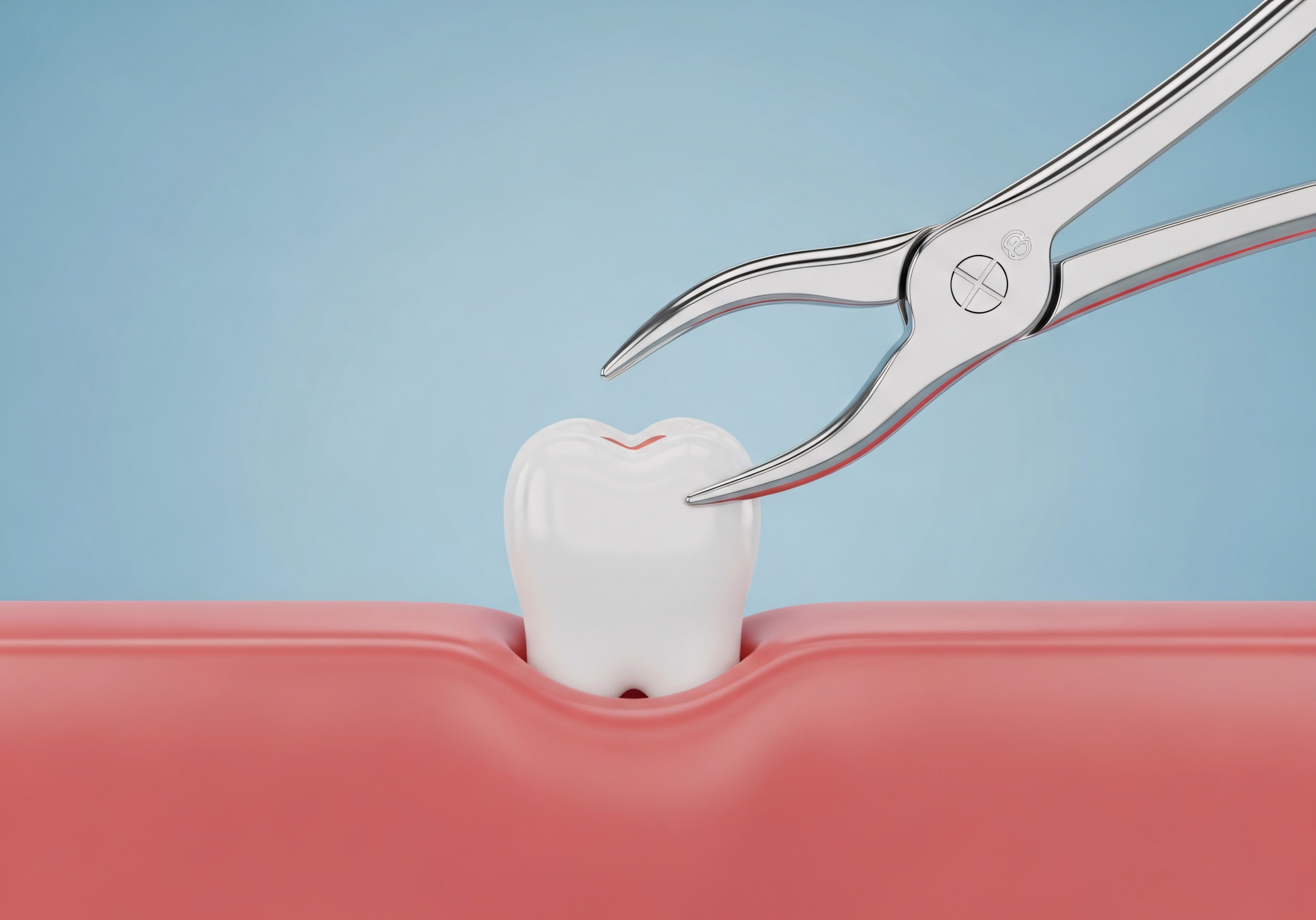 親知らずを抜歯しているイメージ